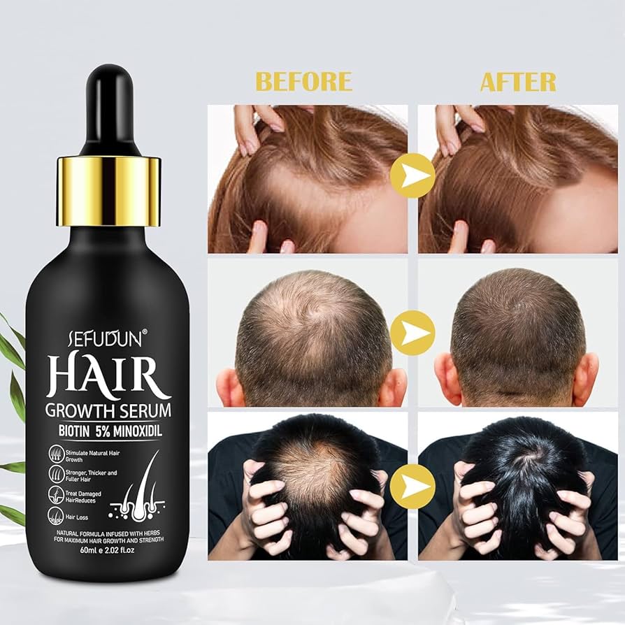 5% Minoxidil Hair Growth Serum for Men and Women, Hair Growth Oil Hair Regrowth Treatment for Scalp Hair Loss Hair Thinning,Stronger, Hair Regrowth Serum for Thicker Longer Fuller Hair A